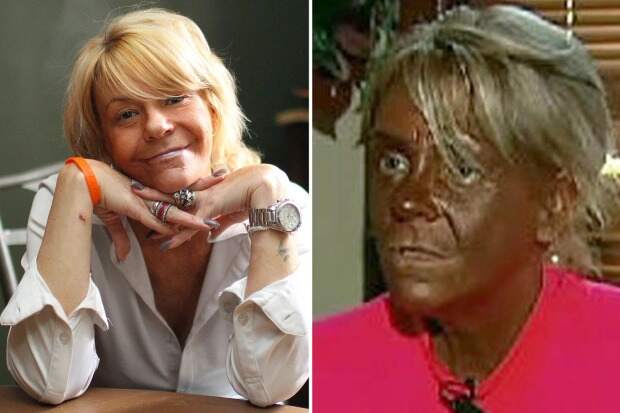 Compulsive over-tanning is a symptom of BDD, treated in NY and NJ. BDD dysmorphia teletherapy treatment nationwide.